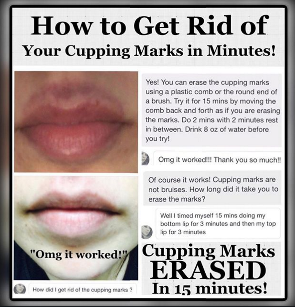 Cupping Blister Treatment: Heal Quickly